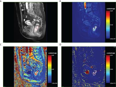 DCE-MRI radiomics models predicting the expression of radioresistant-related factors of LRP-1 and survivin in locally advanced rectal cancer